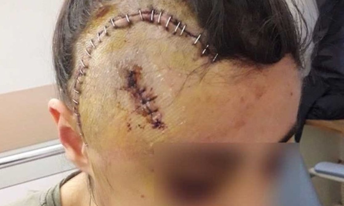Marseille. La jeune fille au crâne fracassé par des policiers porte plainte pour tentative d'homicide