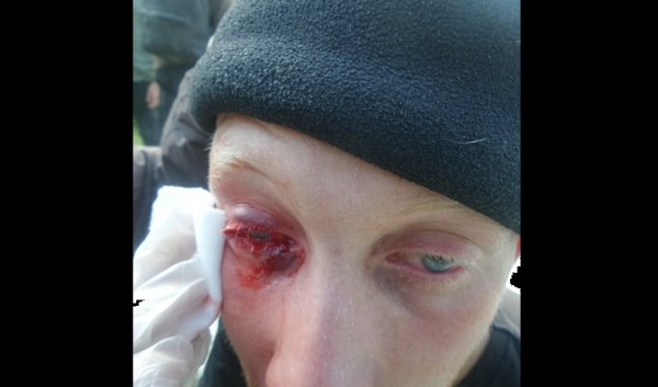 Rassemblements contre les violences policières : un manifestant blessé à l'œil. Il est évacué au CHU